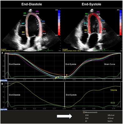 Left ventricular systolic function in subjects conceived through assisted <mark class="highlighted">reproductive technologies</mark>